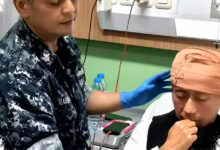 Usai Ditabrak di Bandung, Kepala Yuki Pas Band Harus Dijahit 10 Kali